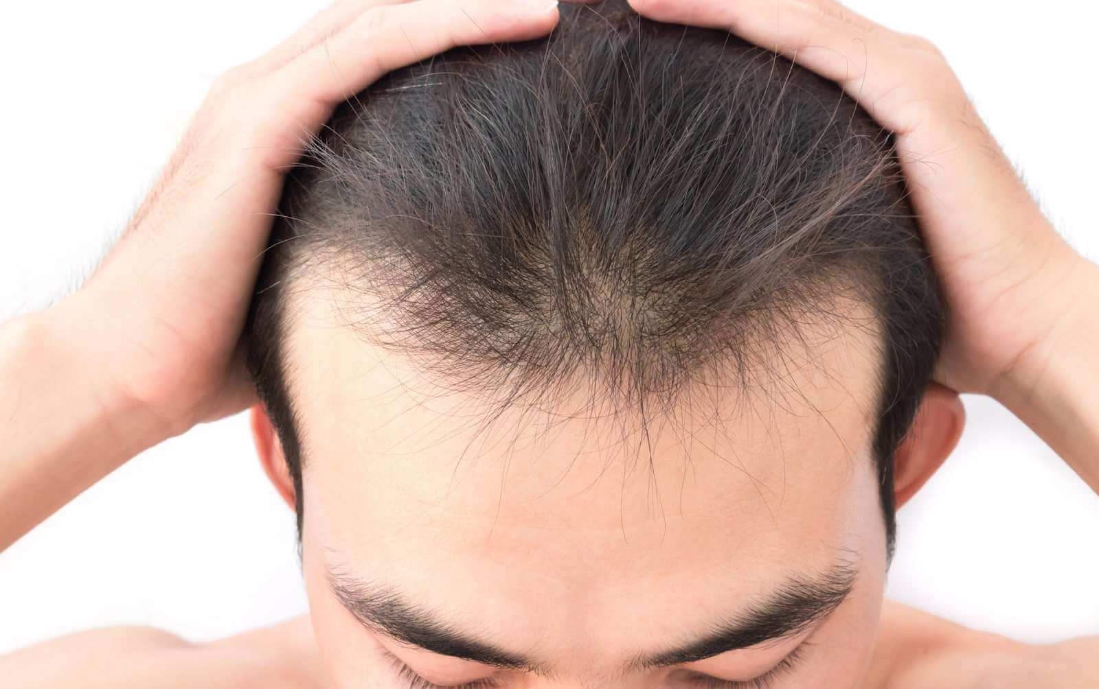 Why Is My Hair So Thin? Possible Reasons For Male Hair Loss