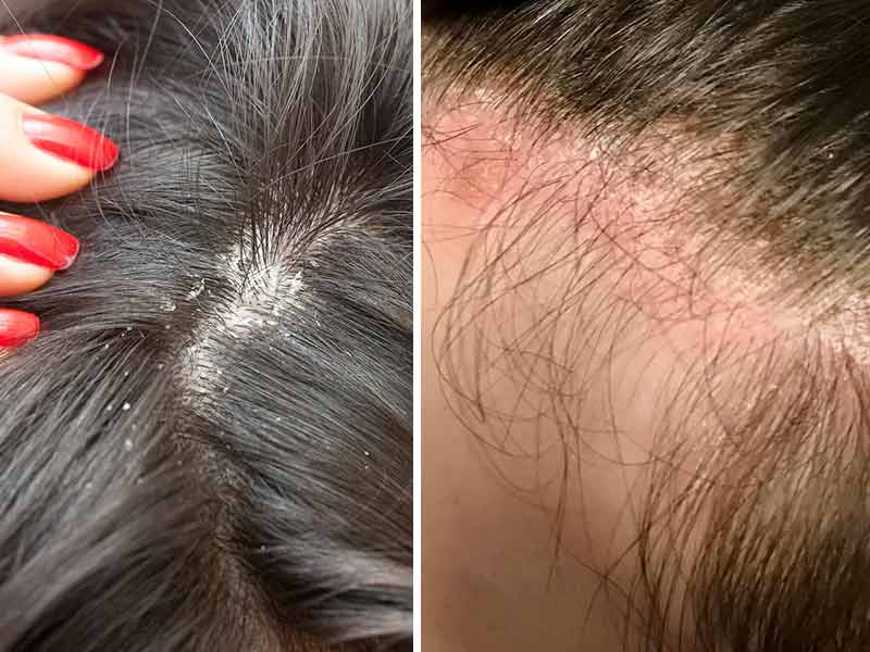 Why Is My Scalp So Itchy &  How To Treat It?