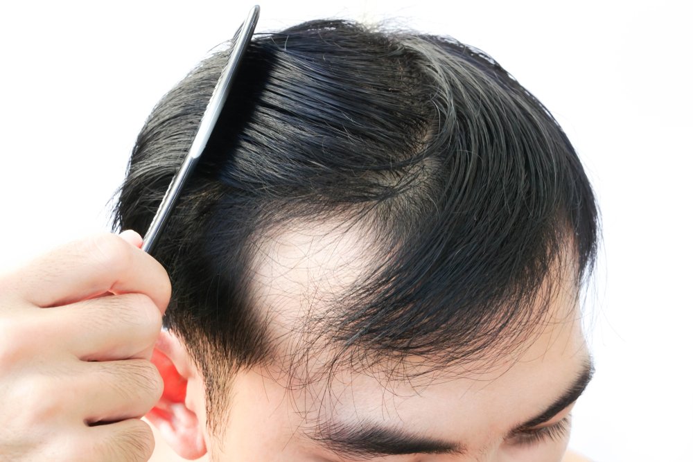 Why Men are Balding in Their 20s