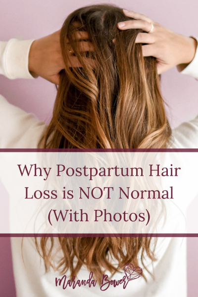 Why Postpartum Hair Loss is NOT Normal (With Photos ...