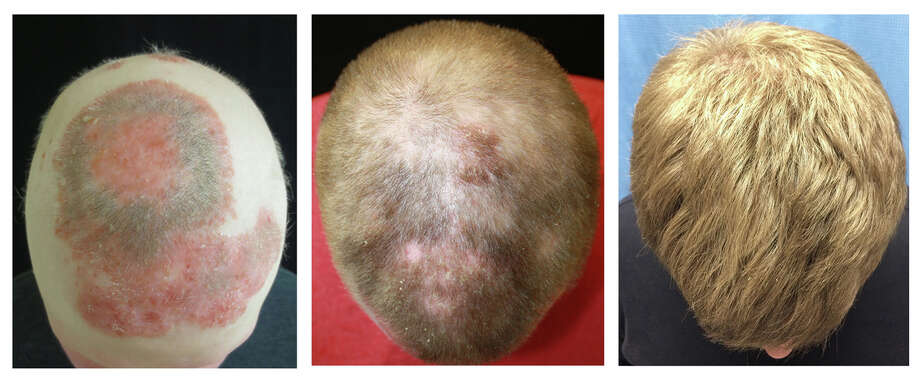 Yale researcher on brink of baldness cure